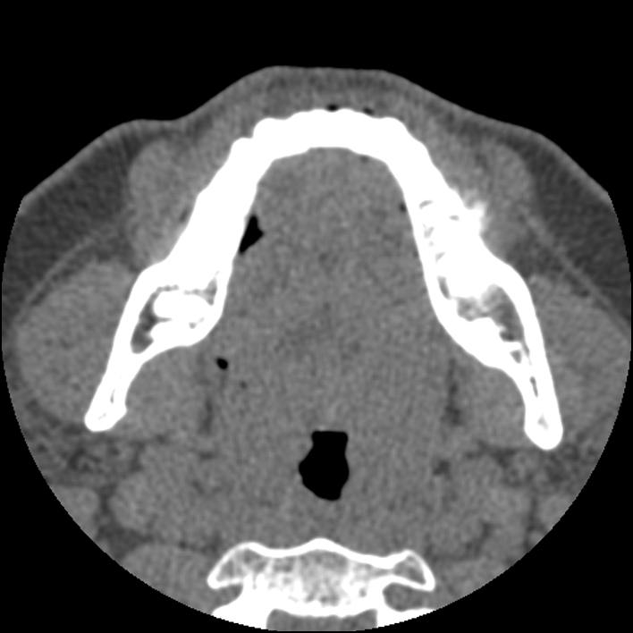 Figure 2 for case Chondroblastic osteosarcoma of the mandible